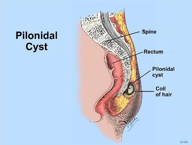 Top 3 Natural Homeopathic Medicines for Pilonidal Cyst Sinus Treatment