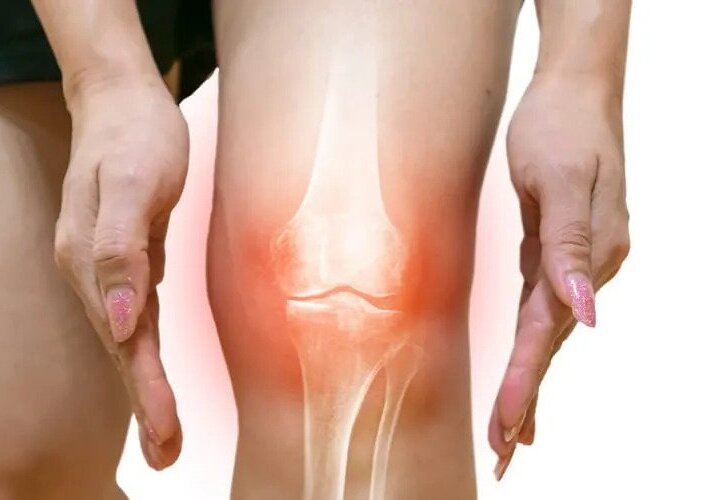 Top 11 Homeopathic Medicines For Knee Arthritis