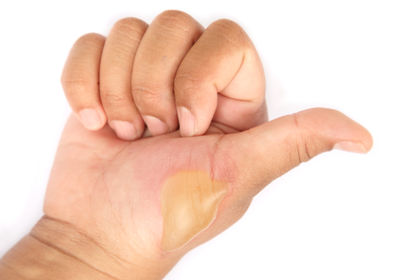 Top Homeopathic Remedies for Burns