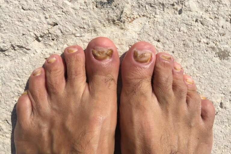 What Causes Nail Fungus, Home Remedy + When to See a Doctor