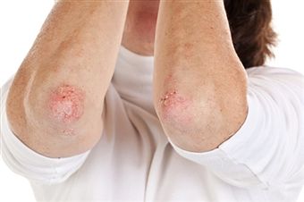 Top 6 Natural Homeopathic Remedies for Shingles and Herpes Treatment